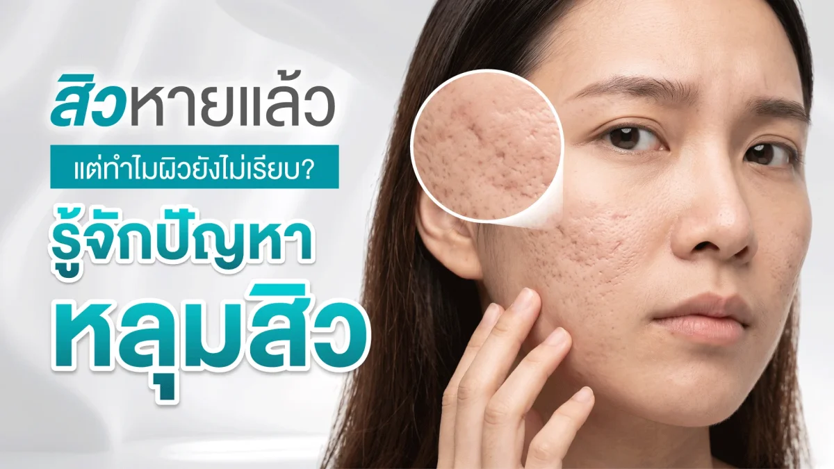 สิวหายแล้ว แต่ทำไมผิวยังไม่เรียบ? รู้จักปัญหาหลุมสิว